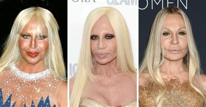 Unveiling The Transformation: Versace's Plastic Surgery Journey
