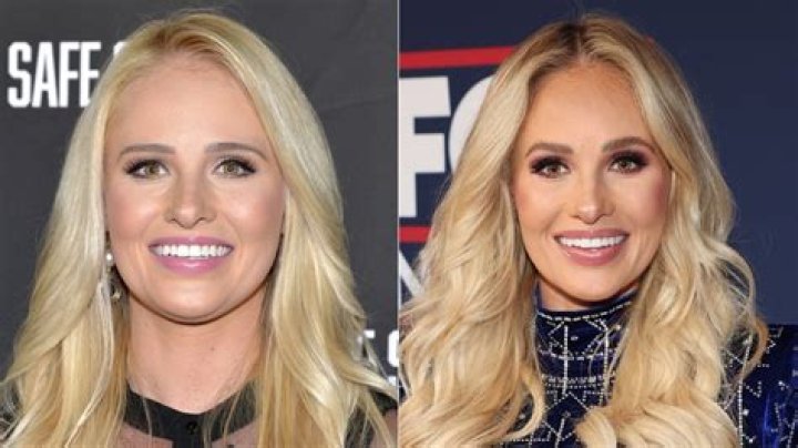 Unveiling The Truth: Tomi Lahren's Breast Implants